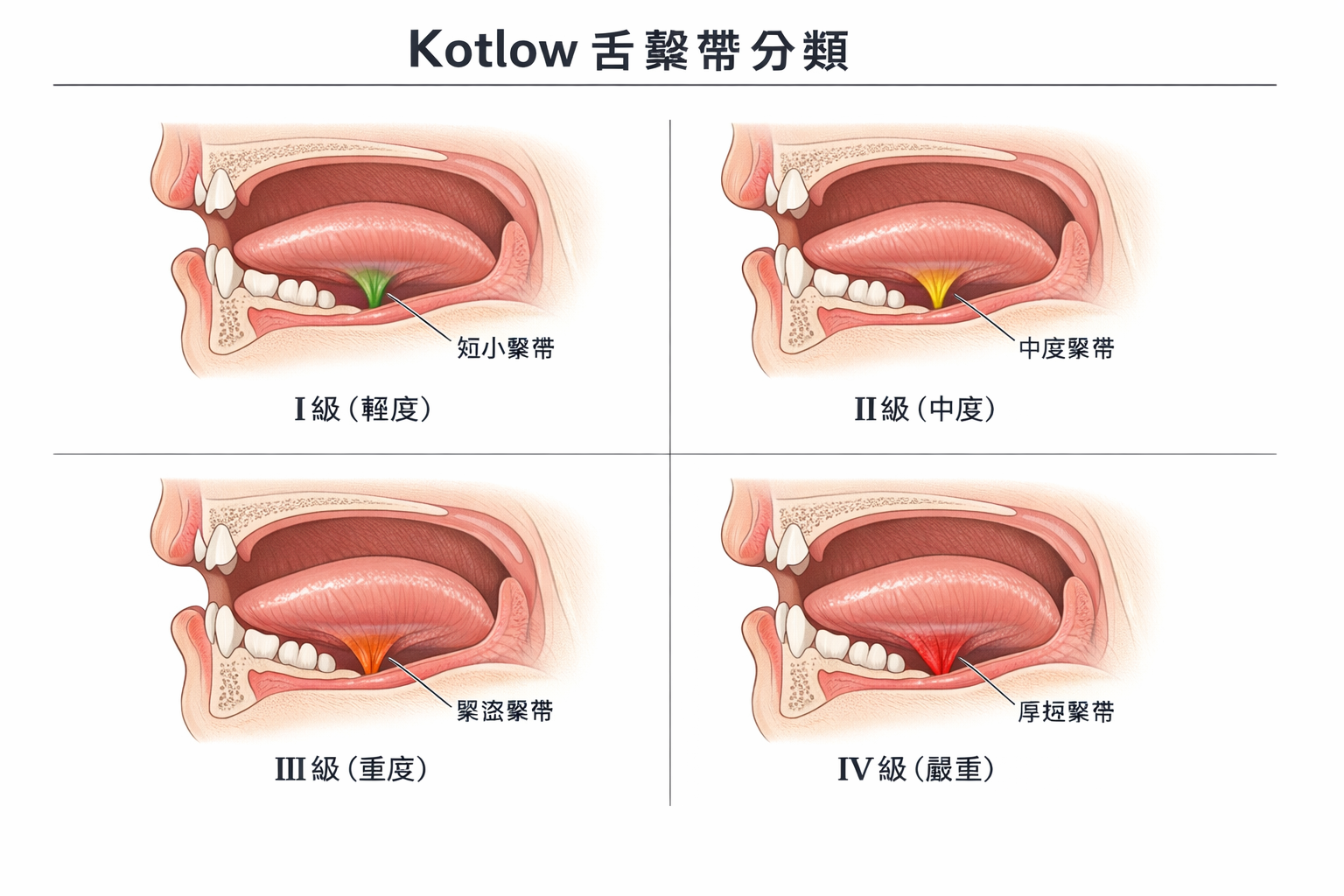 Kotlow 舌繫帶分類 Class I 至 Class IV 示意圖