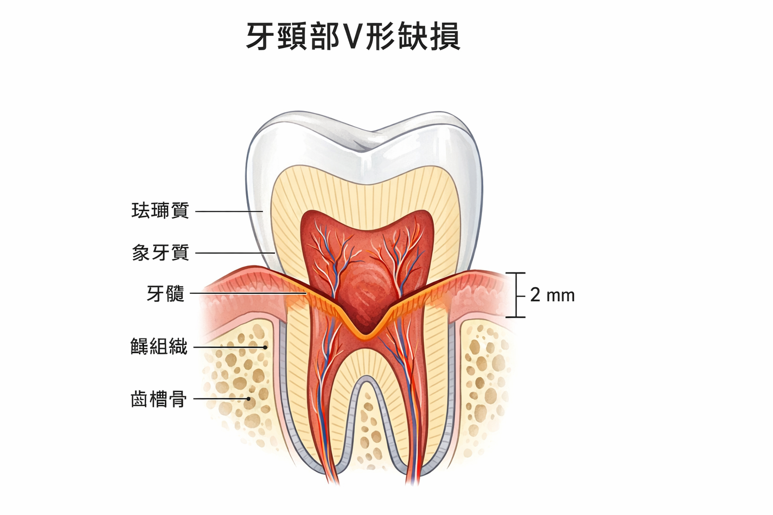 牙頸部非齲性缺損V形凹損示意圖