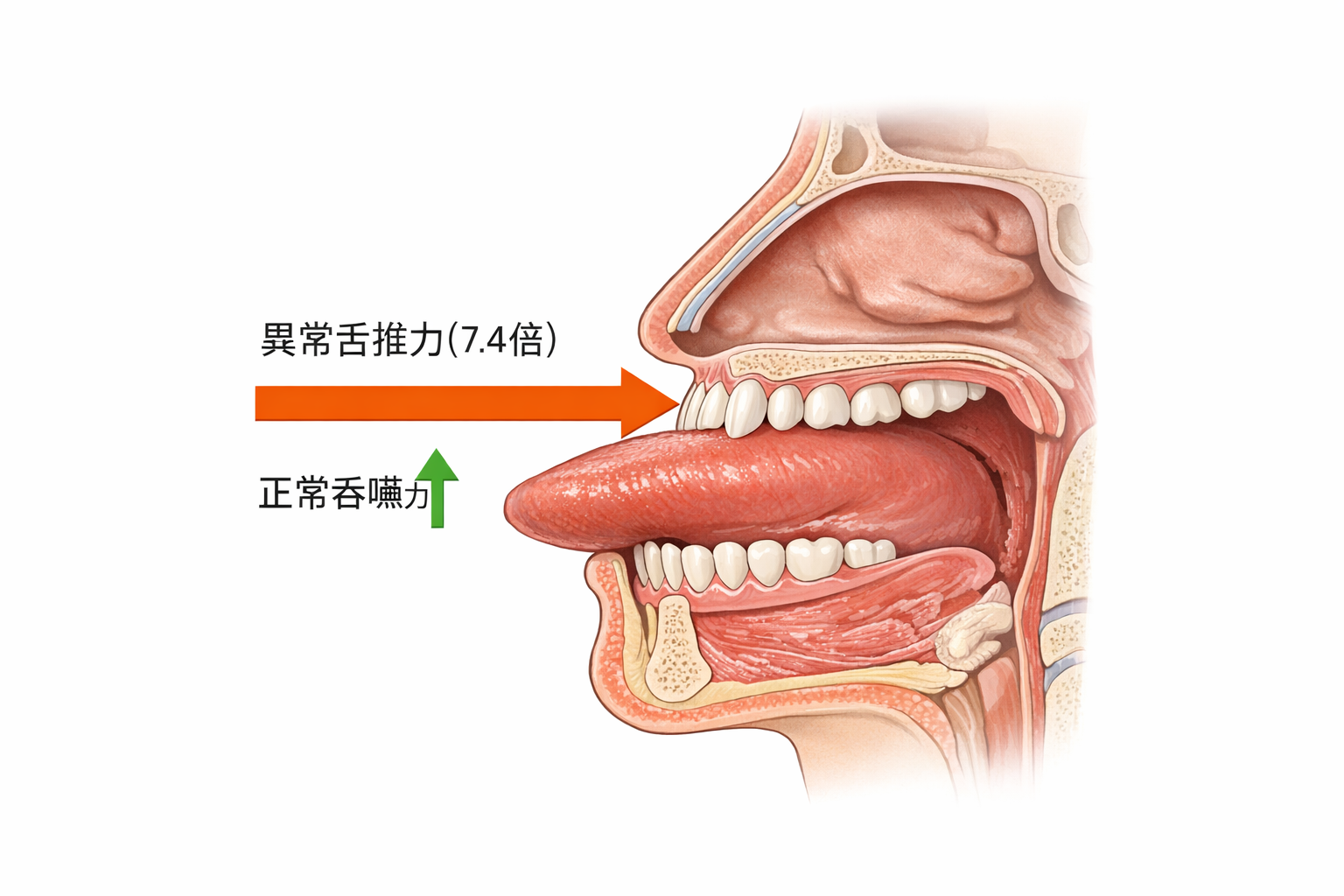 逆吞嚥異常舌推力示意圖（7.4倍）